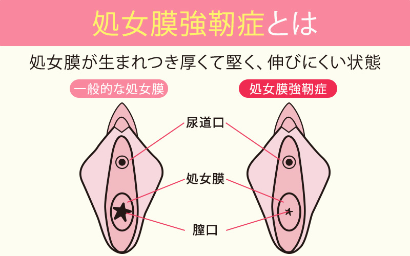 処女膜強靭症